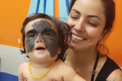 В Краснодаре прооперировали девочку из США с родимым пятном на все лицо