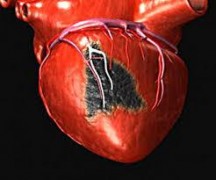 Ишемия сердца часто сопутствует хронической обструктивной болезни легких